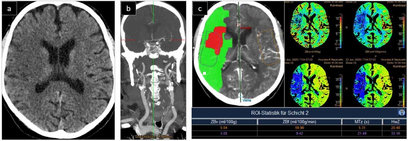 Multimodales CT - Neurovaskuläres Netzwerk NVN Berlin-Brandenburg