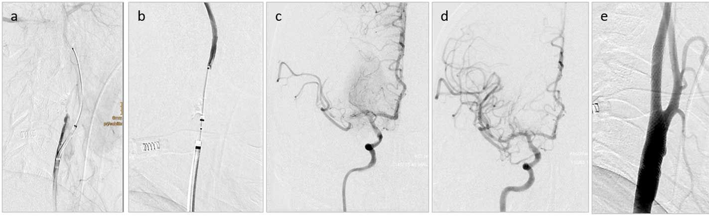 Akutes Stenting ICA-Stenose extrakraniell - Neurovaskuläres Netzwerk NVN Berlin-Brandenburg